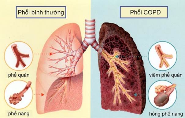 Hỏi: Giải độc phổi có tác dụng gì với bệnh phổi tắc nghẽn mãn tính COPD