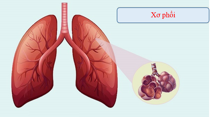 Bệnh xơ phổi nguy hiểm như thế nào? Giải pháp từ thiên nhiên dành cho bệnh nhân xơ phổi