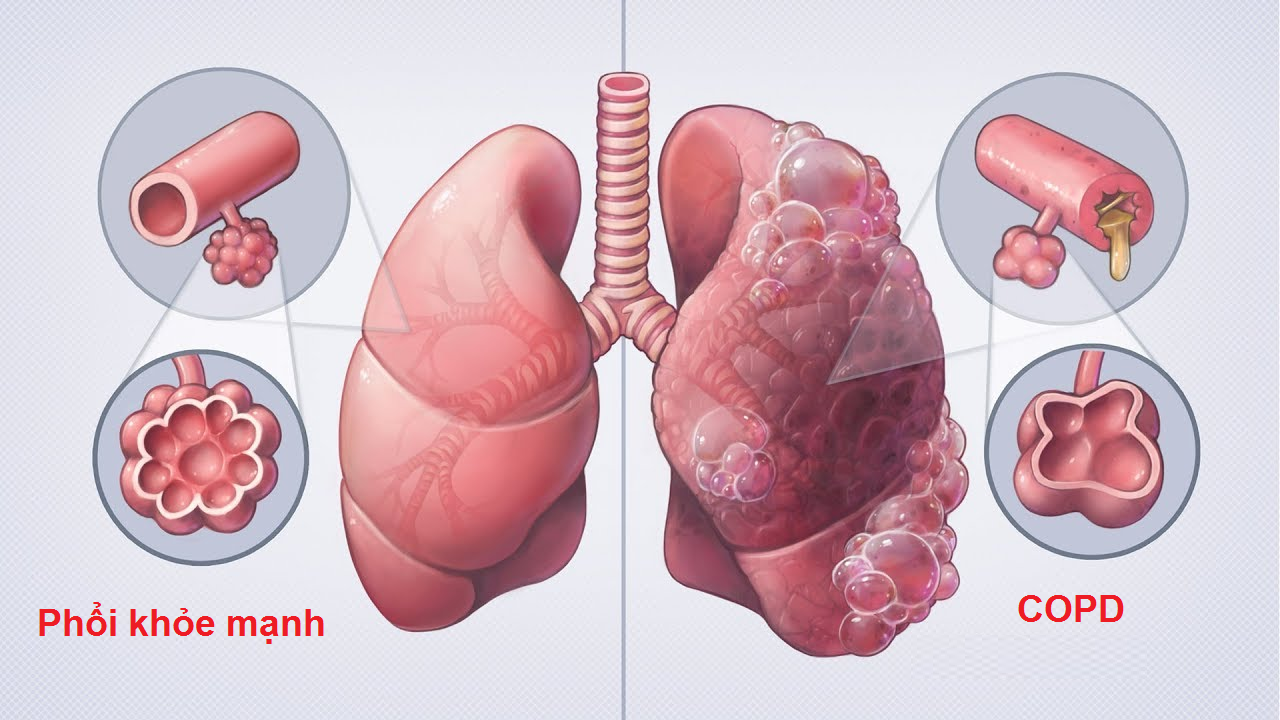 Người bệnh phổi tắc nghẽn mãn tính sống được bao lâu?