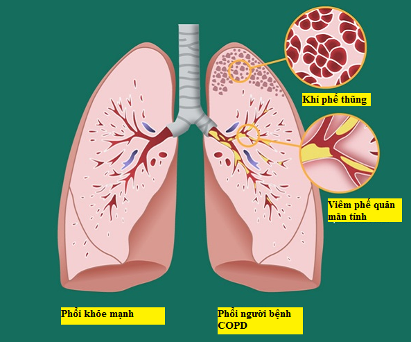 Tràn khí màng phổi – Biến chứng COPD nguy hiểm không thể chủ quan!