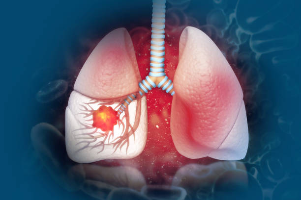 Bí quyết tối ưu giúp phòng ngừa ung thư phổi bạn nhất định phải biết