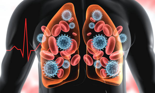 Cách phòng bệnh lao phổi tái phát đơn giản và hiệu quả