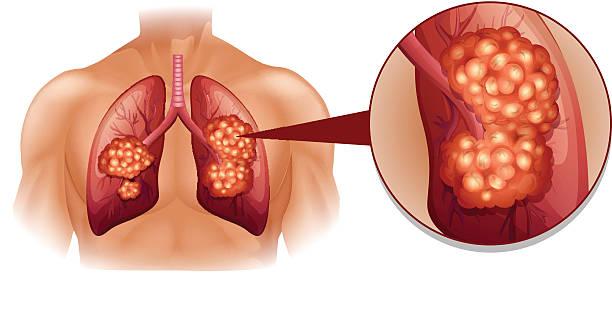 Giảm nguy cơ ung thư phổi bằng cách nào? Giải pháp tối ưu là gì?