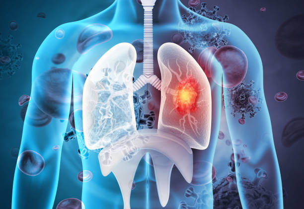 Tìm hiểu các loại viêm phổi thường gặp ở người cao tuổi và cách phòng ngừa hiệu quả