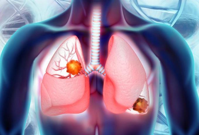 U phổi lành tính: Nguyên nhân, dấu hiệu, cách điều trị và phòng ngừa
