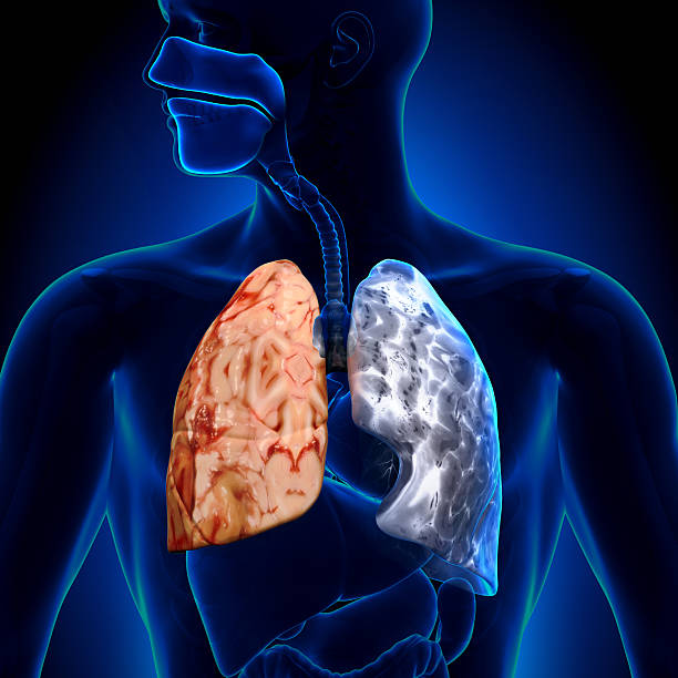 Các nguyên nhân gây COPD thường gặp trong cuộc sống là gì?