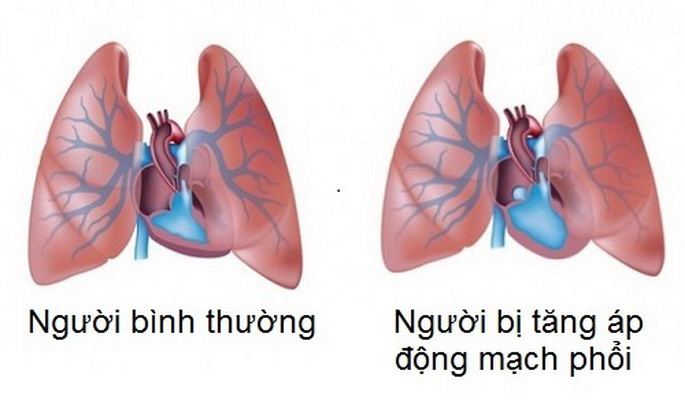 Cảnh giác với tăng áp động mạch phổi ở người bệnh phổi tắc nghẽn mãn tính!