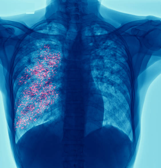 Bệnh phổi kẽ: Nguyên nhân, triệu chứng và cách điều trị