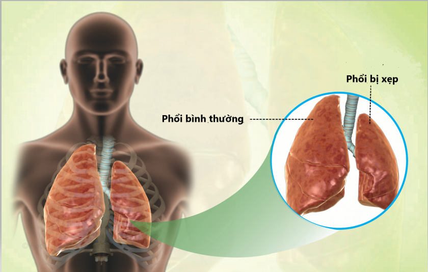 Bệnh xẹp phổi: Nguyên nhân, triệu chứng, chẩn đoán, điều trị và phòng ngừa