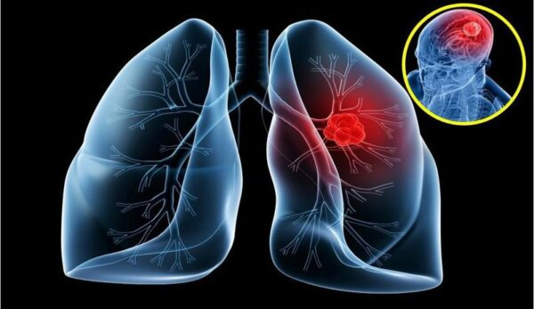 Ung thư phổi di căn sống được bao lâu?